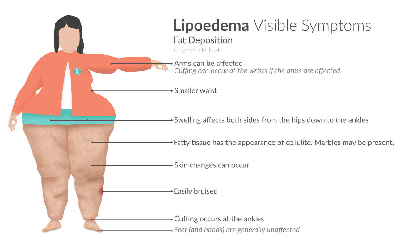 If you have lipedema, weight gain is a disorder and not your fault